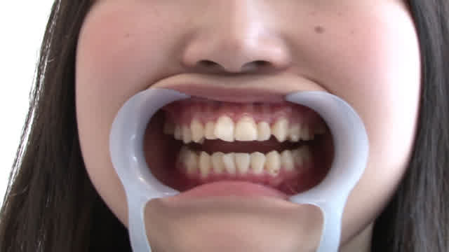 最新の技術と設備を持った… 歯フェチ！本物歯治療映像虫歯掘削処置 堀越まき