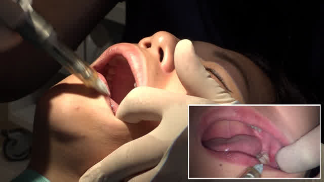 最新の技術と設備を持った… 本物歯科治療映像 左下6，7番銀歯治療 星野桃子